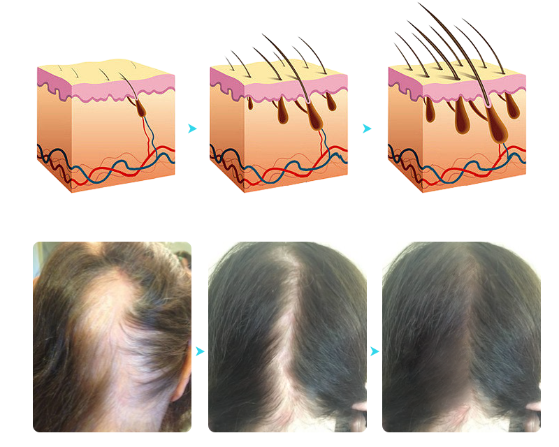 Sugoola™ LLLT Niedrige Energie Rot Blau Licht Bestrahlung Haar Haarwuchs und Öl Kontrolle Kopfhaut Pflege Kamm (FDA-zugelassen)