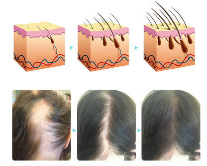 Sugoola™ LLLT Niedrige Energie Rot Blau Licht Bestrahlung Haar Haarwuchs und Öl Kontrolle Kopfhaut Pflege Kamm (FDA-zugelassen)