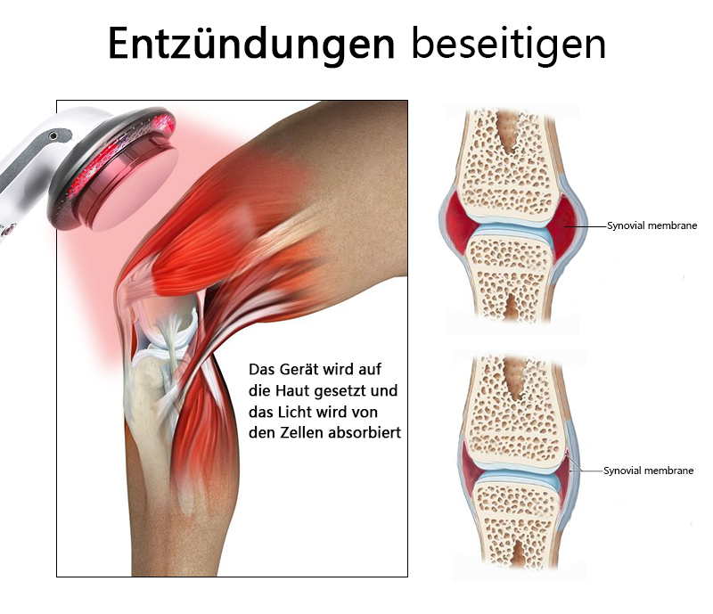 Ourlyard™ Handgerät zur Kaltlaser-Schmerzbehandlung