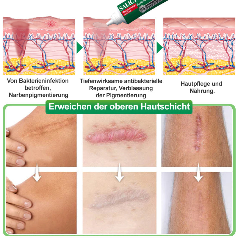 Ourlyard™ Salicylsäure-Narbenentfernungs-Gel