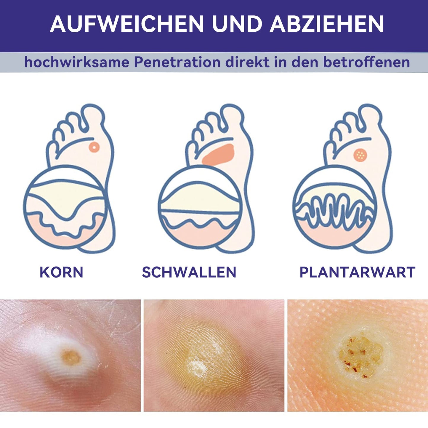 Furzero™ Leistungsstarke Flüssigmaske zur Entfernung von Warzen und Hühneraugen