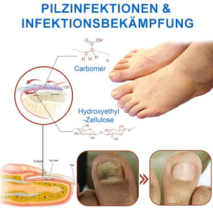 Ourlyard™ Effizientes Lichttherapiegerät zur Behandlung von Nagelerkrankungen