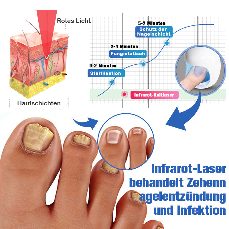 Furzero™ Nagelpilzreinigung Laser Linderungsgerät