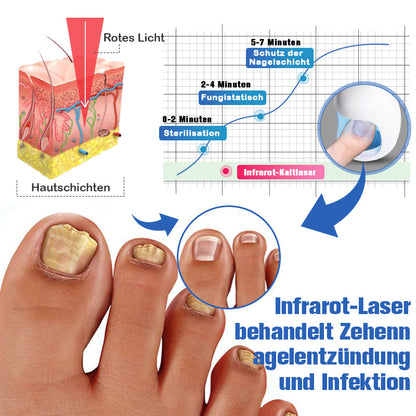 Furzero™ Nagelpilzreinigung Laser Linderungsgerät