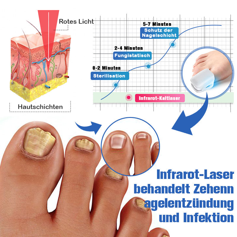 Furzero™ Nagelpilz-Laserbehandlungsgerät